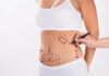 Liposukcja laserowa – podstawowe informacje na temat zabiegu Liposukcja laserowa